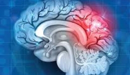 استروک ایسکمیک