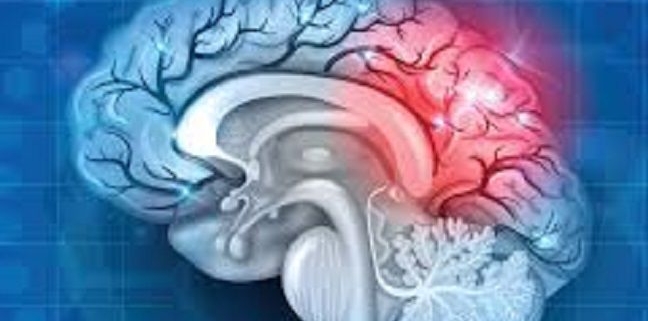 استروک ایسکمیک