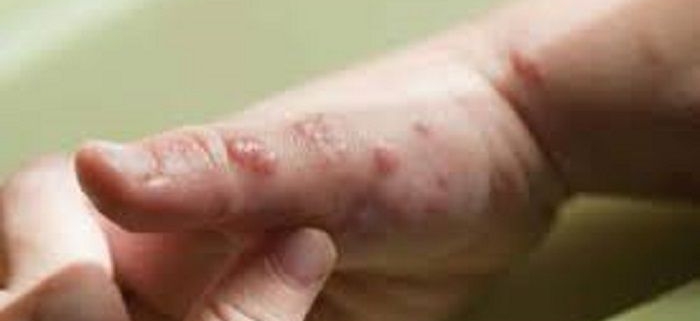 بيماری های قارچی پوست