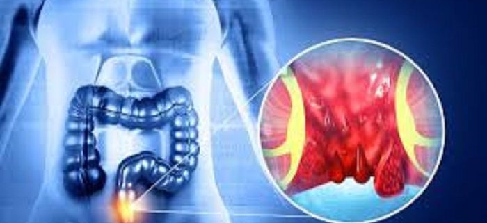 هموروئیدها : ویژگی و انواع آنها